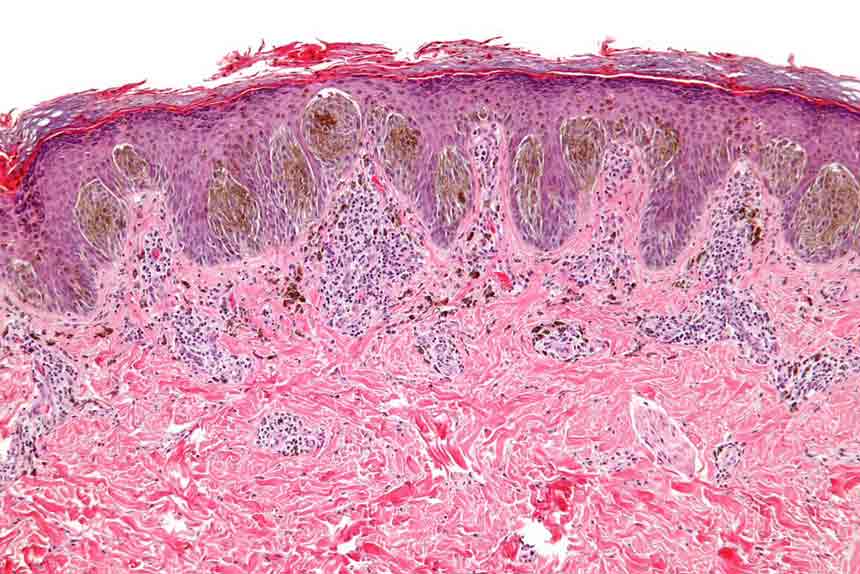 CareAcross-spitz-nevus-melanoma